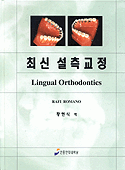 최신 설측교정