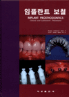 임플란트 보철 : Clinical and laboratory procedures